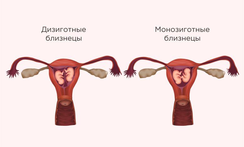 Photo of Беременность с двойней: особенности